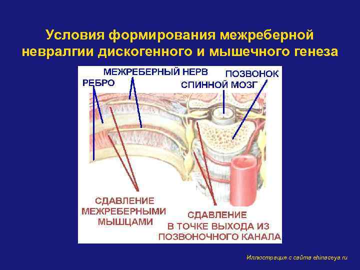 Условия формирования межреберной невралгии дискогенного и мышечного генеза Иллюстрация с сайта ehinaceya. ru 