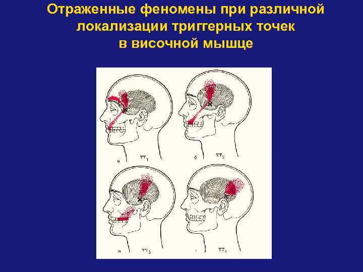 Отраженные феномены при различной локализации триггерных точек в височной мышце 