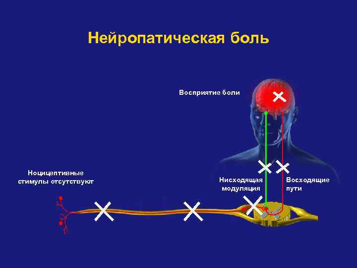 Нейропатическая боль Восприятие боли Ноцицептивные стимулы отсутствуют Нисходящая модуляция Восходящие пути 