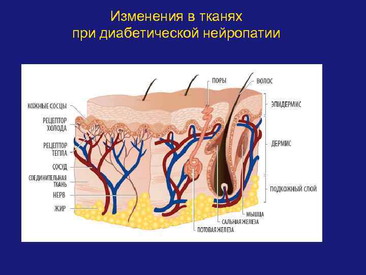 Изменения в тканях при диабетической нейропатии 