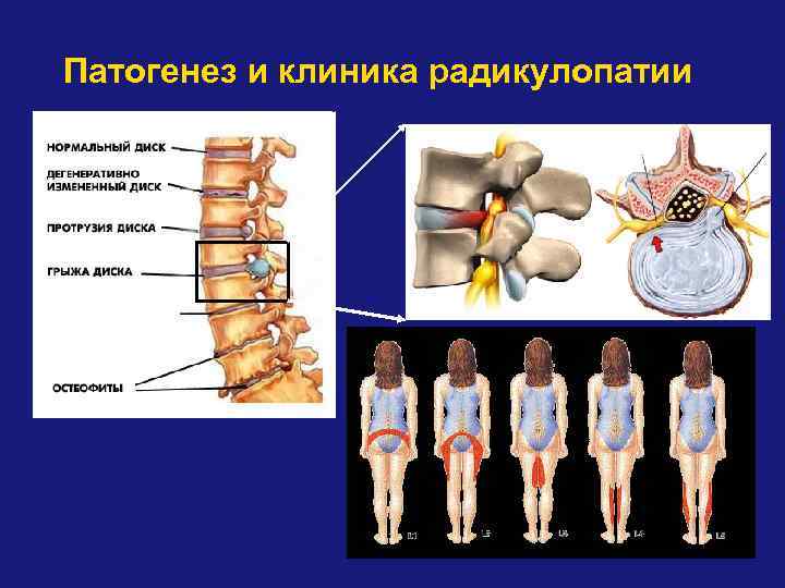 Патогенез и клиника радикулопатии 