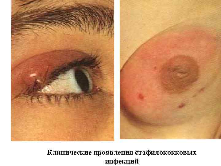 Клинические проявления стафилококковых инфекций 
