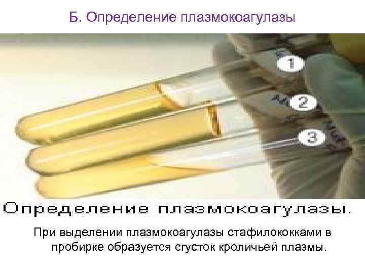 Б. Определение плазмокоагулазы При выделении плазмокоагулазы стафилококками в пробирке образуется сгусток кроличьей плазмы. 