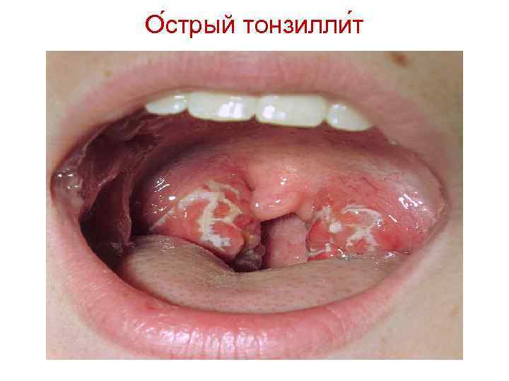 О стрый тонзилли т 