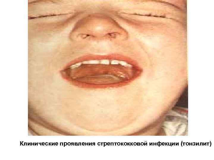 Клинические проявления стрептококковой инфекции (тонзилит) 