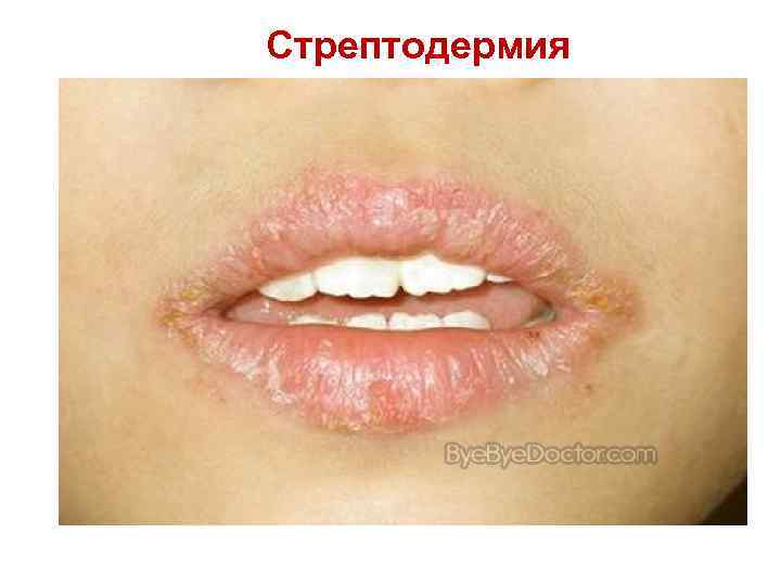Стрептодермия 