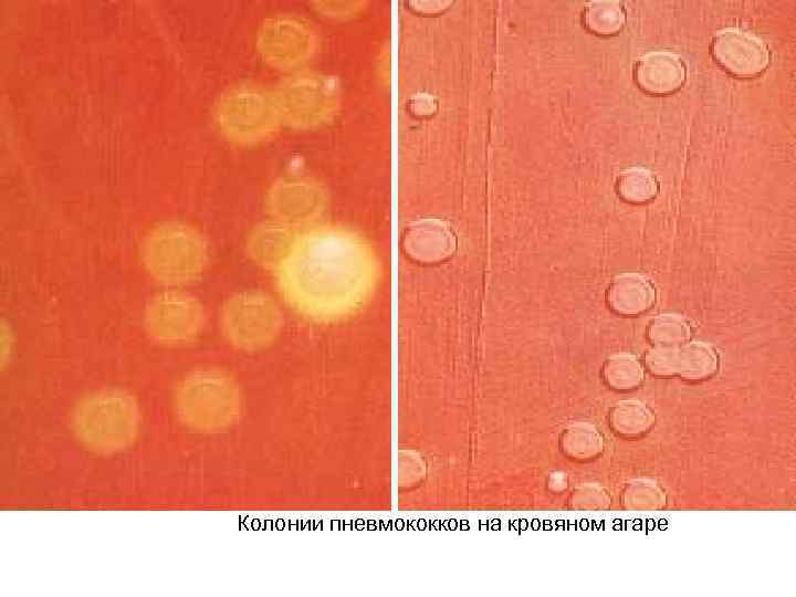 Колонии пневмококков на кровяном агаре 