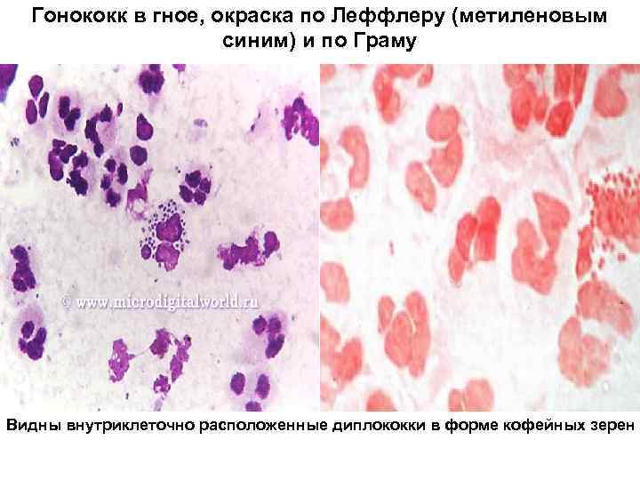 Гонококк в гное, окраска по Леффлеру (метиленовым синим) и по Граму Видны внутриклеточно расположенные