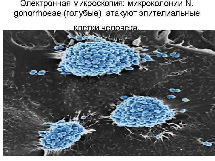 Электронная микроскопия: микроколонии N. gonorrhoeae (голубые) атакуют эпителиальные клетки человека. 