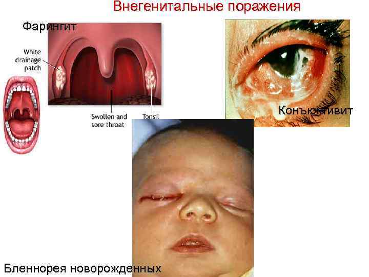 Внегенитальные поражения Фарингит Конъюктивит Бленнорея новорожденных 