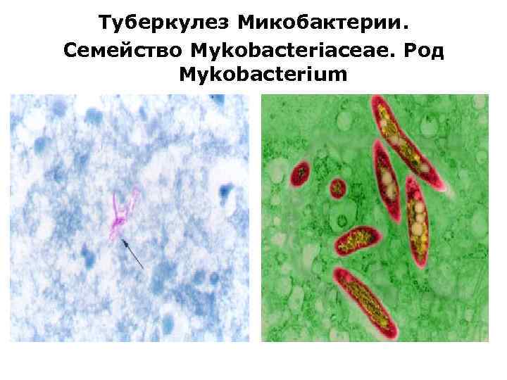 Туберкулез Микобактерии. Семейство Mykobacteriaceae. Род Mykobacterium 