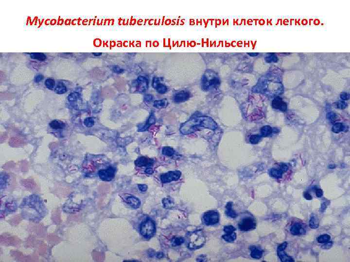 Mycobacterium tuberculosis внутри клеток легкого. Окраска по Цилю-Нильсену 