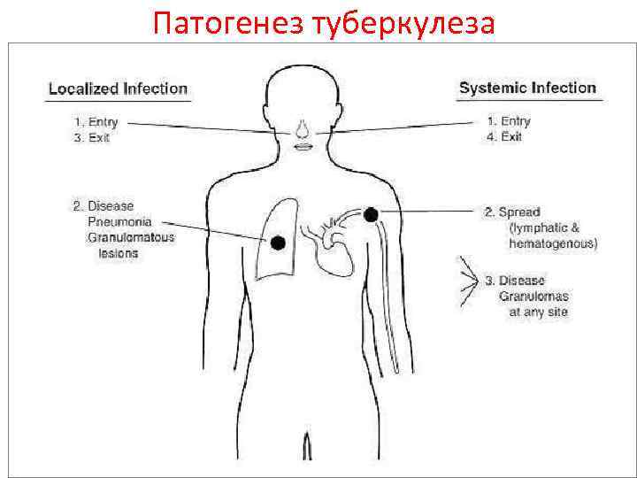 Патогенез туберкулеза 