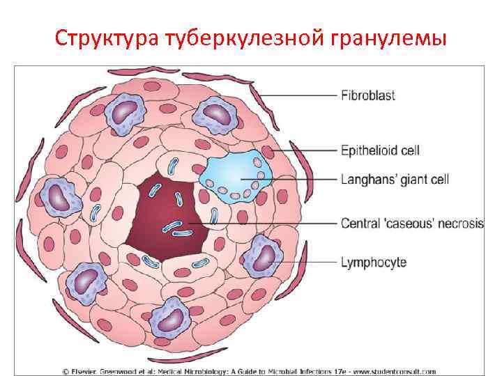 Структура туберкулезной гранулемы 