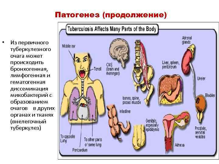  Патогенез (продолжение) • Из первичного туберкулезного очага может происходить бронхогенная, лимфогенная и гематогенная