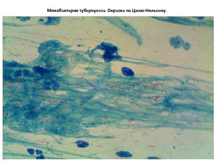 Микобактерии туберкулеза. Окраска по Цилю-Нильсену. 
