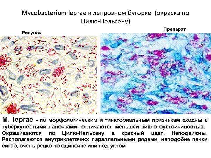 Mycobacterium leprae в лепрозном бугорке (окраска по Цилю-Нельсену) Рисунок M. leprae Препарат - по