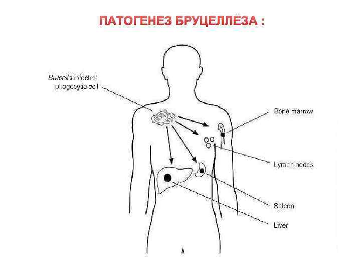 ПАТОГЕНЕЗ БРУЦЕЛЛЁЗА : 