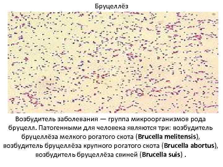 Бруцеллёз Возбудитель заболевания — группа микроорганизмов рода бруцелл. Патогенными для человека являются три: возбудитель