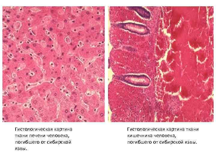 Гистологическая картина ткани печени человека, погибшего от сибирской язвы. Гистологическая картина ткани кишечника человека,