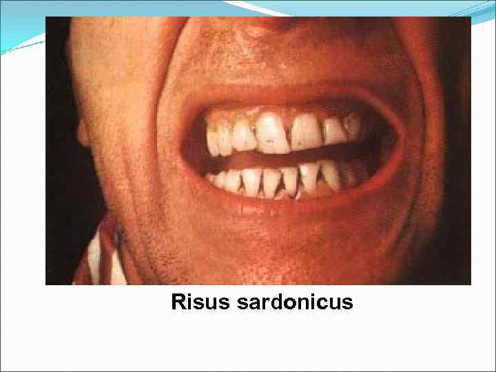 Risus sardonicus 