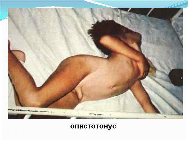 опистотонус 