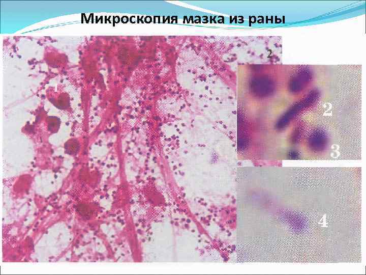 Микроскопия мазка из раны . 