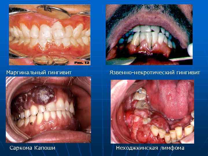Маргинальный гингивит Саркома Капоши Язвенно-некротический гингивит Неходжкинская лимфома 