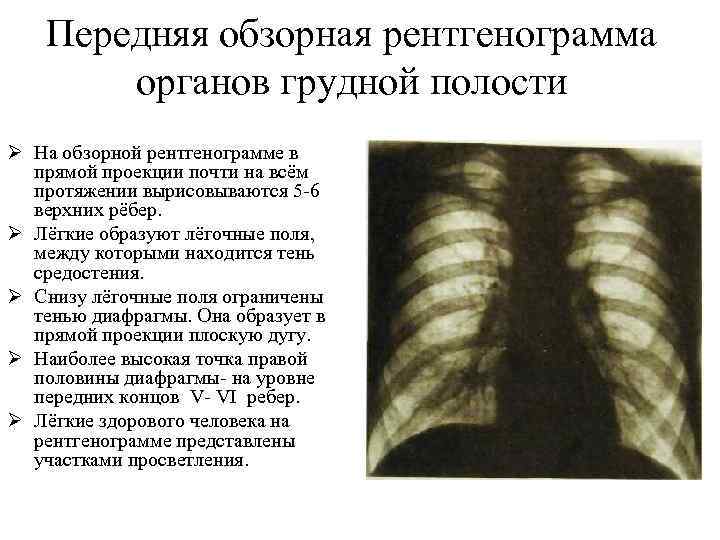 Передняя обзорная рентгенограмма органов грудной полости Ø На обзорной рентгенограмме в прямой проекции почти
