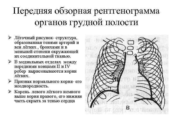 Передняя обзорная рентгенограмма органов грудной полости Ø Лёгочный рисунок- структура, образованная тенями артерий и