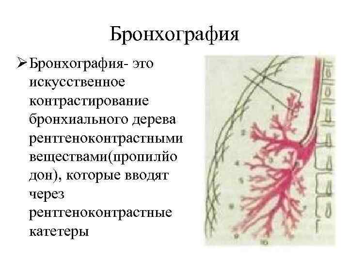 Бронхография Ø Бронхография- это искусственное контрастирование бронхиального дерева рентгеноконтрастными веществами(пропилйо дон), которые вводят через