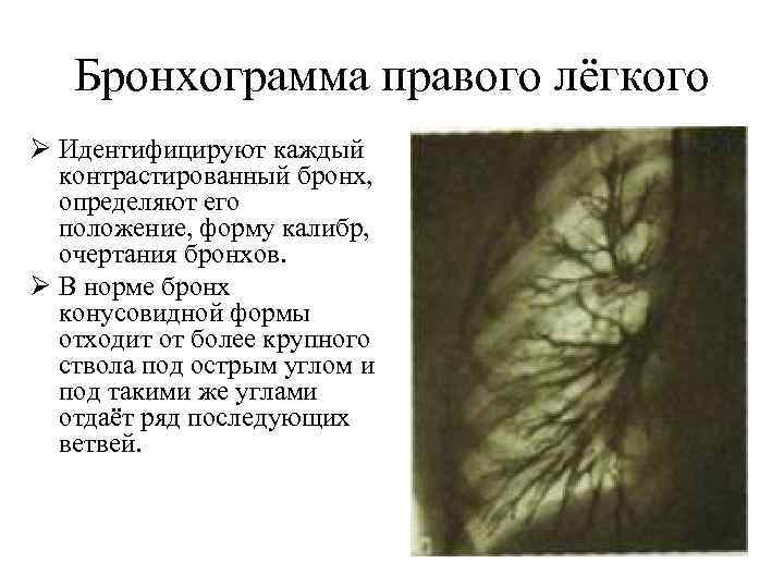 Бронхограмма правого лёгкого Ø Идентифицируют каждый контрастированный бронх, определяют его положение, форму калибр, очертания
