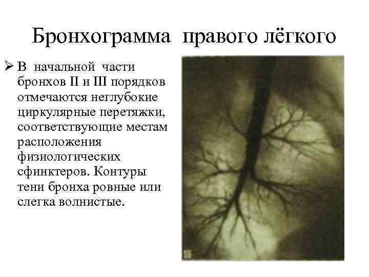 Бронхограмма правого лёгкого Ø В начальной части бронхов II и III порядков отмечаются неглубокие