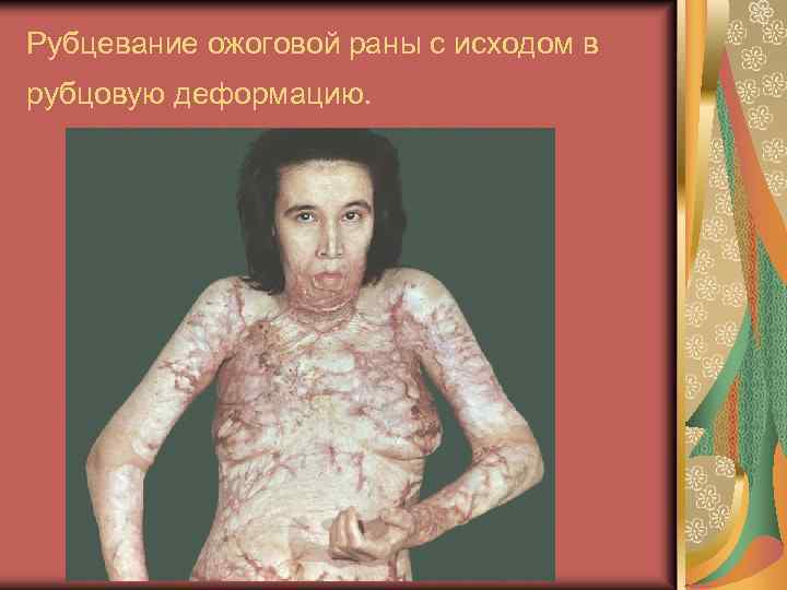 Рубцевание ожоговой раны с исходом в рубцовую деформацию. 