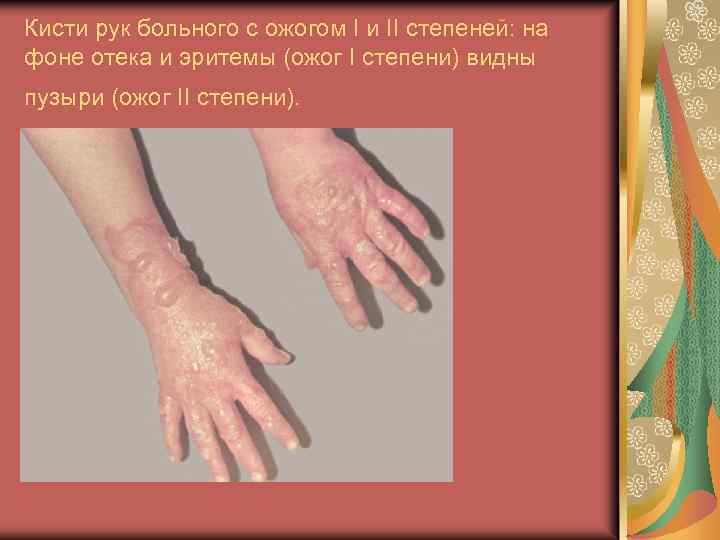 Кисти рук больного с ожогом I и II степеней: на фоне отека и эритемы