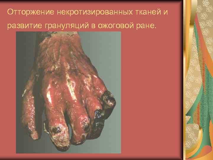 Отторжение некротизированных тканей и развитие грануляций в ожоговой ране. 