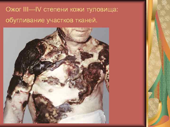 Ожог III—IV степени кожи туловища: обугливание участков тканей. 