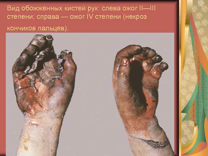 Вид обожженных кистей рук: слева ожог II—III степени; справа — ожог IV степени (некроз