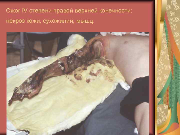 Ожог IV степени правой верхней конечности: некроз кожи, сухожилий, мышц. 