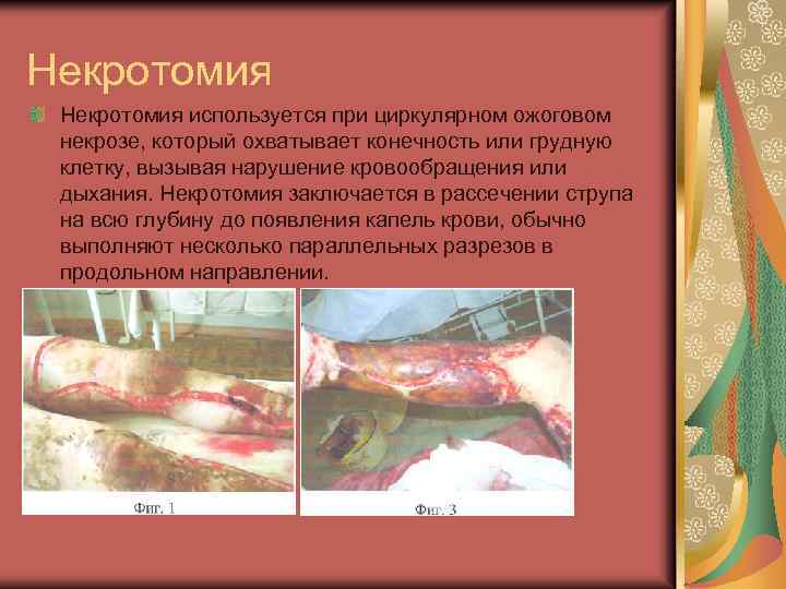 Некротомия используется при циркулярном ожоговом некрозе, который охватывает конечность или грудную клетку, вызывая нарушение