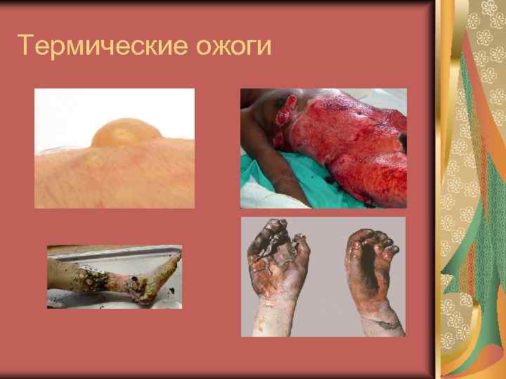 Термические ожоги 
