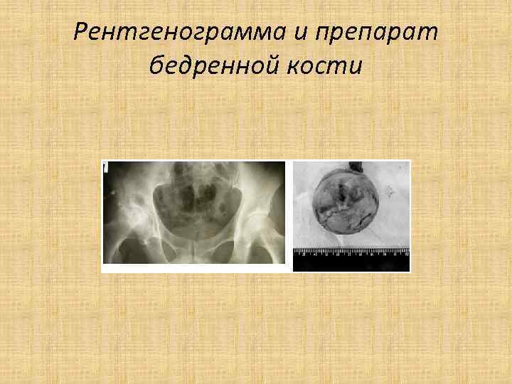 Мкб 10 асептический некроз головки бедренной