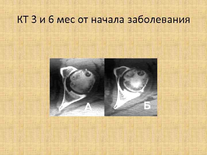 КТ 3 и 6 мес от начала заболевания 