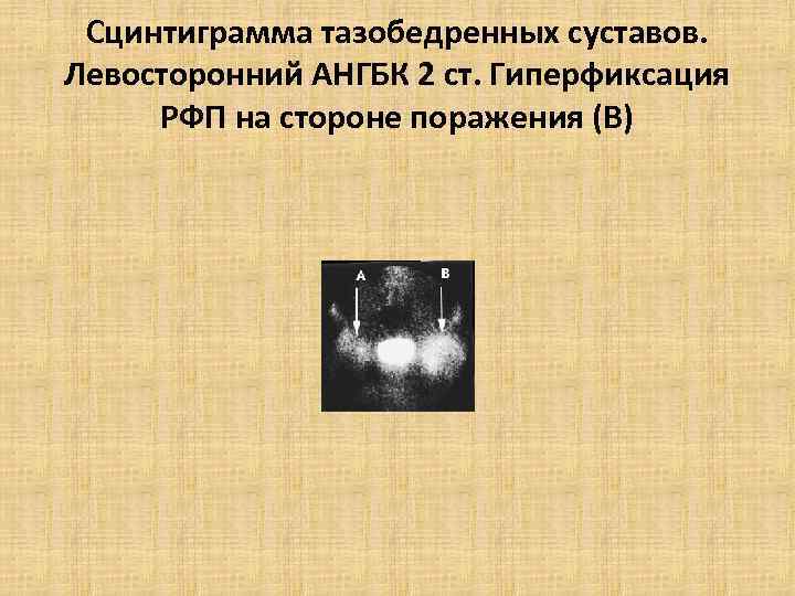 Гиперфиксация это. Гиперфиксация. Очаги патологической гиперфиксации. Очаг гиперфиксации РФП что это.