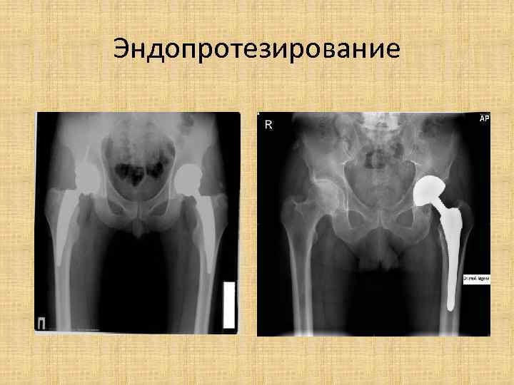 Асептический некроз головки правой бедренной кости. Асептический некроз головки бедра эндопротезирование. Эндопротезирование тазобедренного сустава при асептическом некрозе. Некроз головки тазобедренного сустава профилактика. Асептический некроз головки эндопротез.