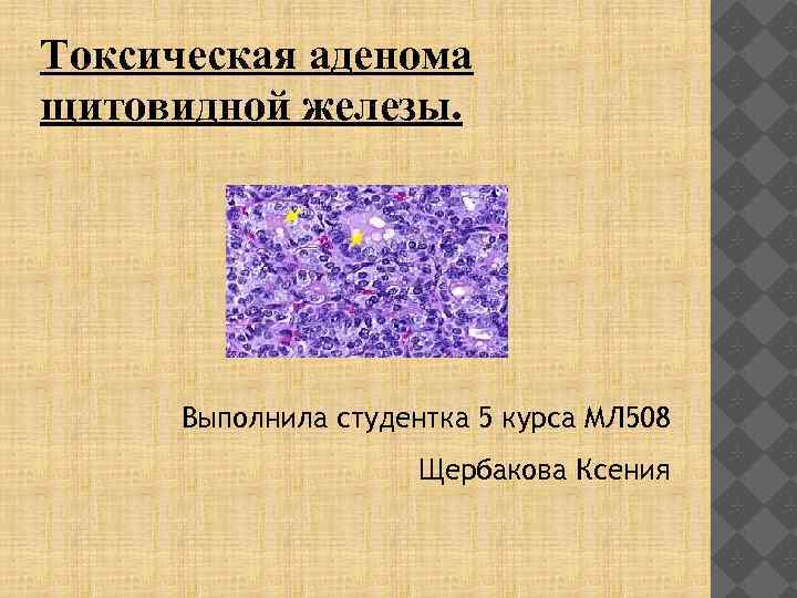 Аденома щитовидной железы. Токсическая аденома щитовидной железы. Солитарные токсические аденомы щитовидной железы. Аденома щитовидной железы презентация. Презентация токсическая аденома щитовидной железы.