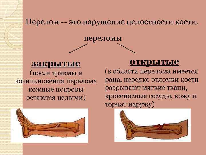 Какой вид травмы показан на рисунке. Симптоматика перелома кости. Переломы Косте конечностей. Открытые и закрытые передома.