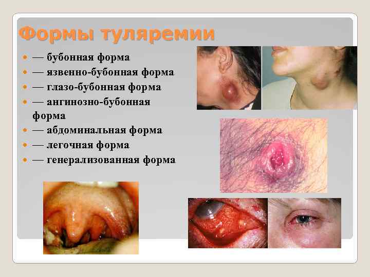 Формы туляремии — бубонная форма — язвенно-бубонная форма — глазо-бубонная форма — ангинозно-бубонная форма