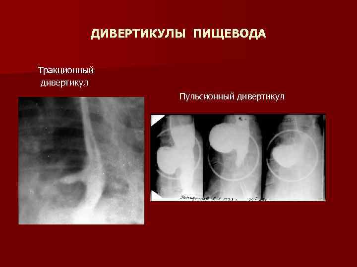 ДИВЕРТИКУЛЫ ПИЩЕВОДА Тракционный дивертикул Пульсионный дивертикул 