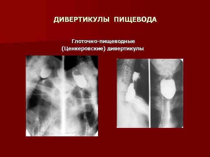 Заболевания пищевода хирургия презентация